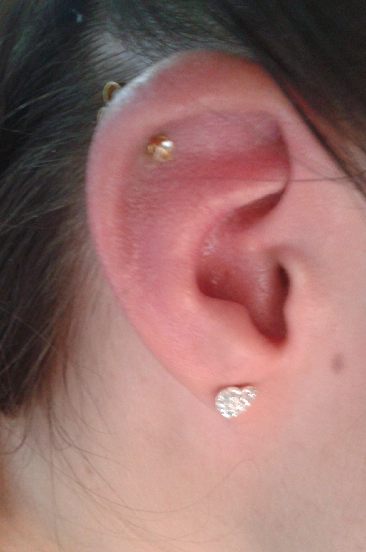 swollen ear cartilage